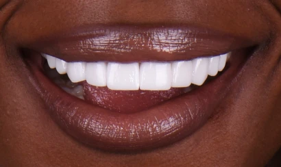 before and after, treatment 3 on 6 implants in San Miguel de Allender