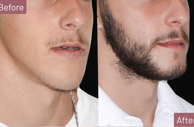 Before and after facial reduction surgery comparison on male patient