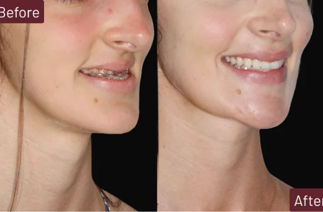 Before and after results of chin implant procedure in Mexico