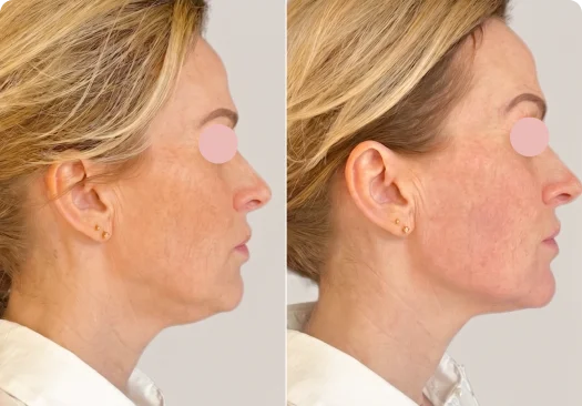 Woman before and after mentoplasty surgery package results