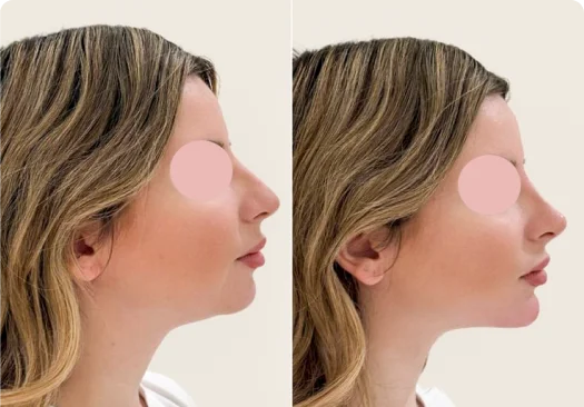Side by side comparison of rhinoplasty and mentoplasty outcomes
