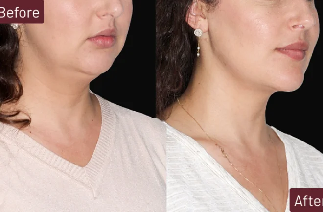 Side profile before and after chin surgery results on female patient