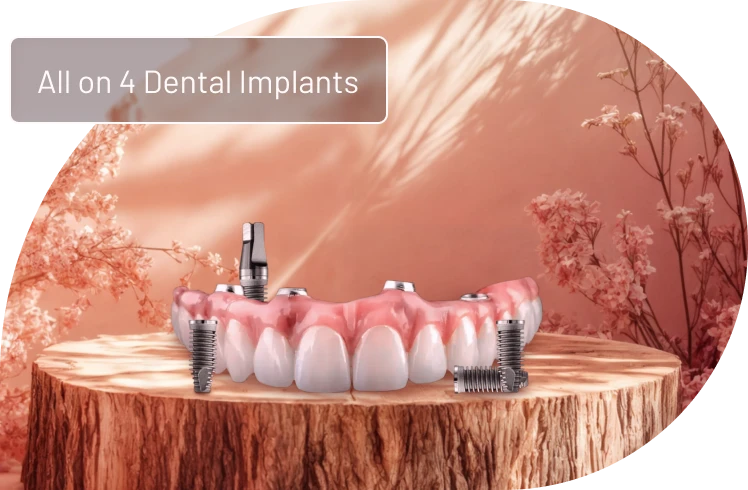 denture prosthesis used in All-on-4 dental implants to restore a full arch.