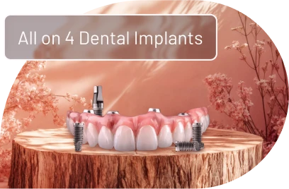 denture prosthesis used in All-on-4 dental implants to restore a full arch.
