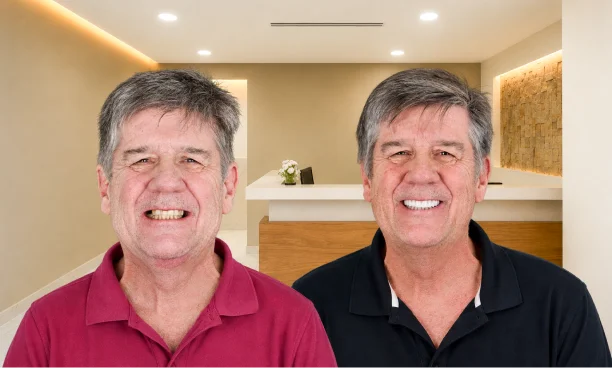 Two patients smiling after completing the All on 4 dental implants single-trip package.