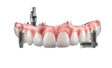 All-on-4 denture superstructure supported by four implants—cost-effective full mouth restoration in Mexico.