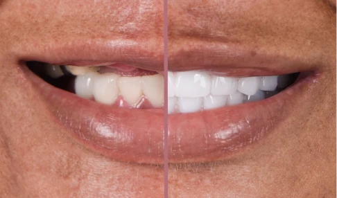 before and after, treatment all on 4 implants in San Miguel de Allender