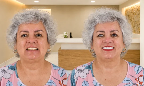 Woman patient before and after picture, one with all on 4 results