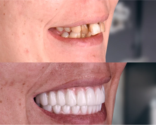 Side-by-side image of a woman smiling before and after dental treatment—showing natural, uneven teeth in the first photo and a bright, aligned smile in the second.