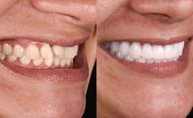 Before and after smile restoration with All on 4 dental implants.