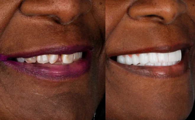 Before and after transformation using All on 4 dental implants for missing teeth.