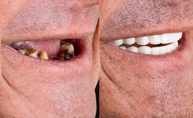Full arch restoration before and after All on 4 dental implant treatment.
