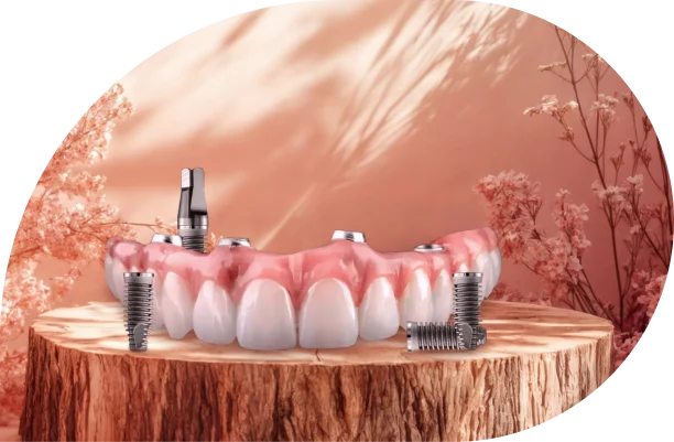Illustration showing a full-arch prosthesis supported by four dental implants.