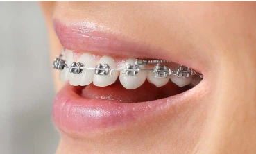 Young woman with braces smiling joyfully, showcasing teeth nearing perfect alignment after successful orthodontic treatment.
