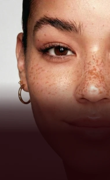 Brow lift procedure in San Miguel de Allende, enhancing facial aesthetics with expert cosmetic facial surgery by experienced surgeons in Mexico.
