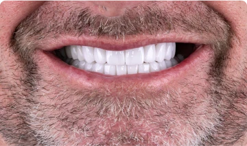 mid-aged man with wide smile showcasing bright smile made of emax porcelain crowns.