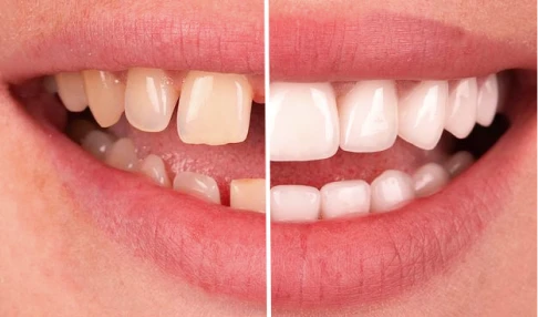 before and after, treatment snap on dentures in San Miguel de Allender