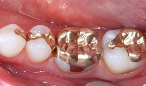 before and after, treatment 3 on 6 implants in San Miguel de Allender