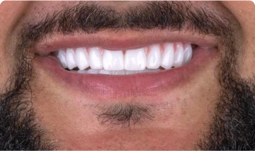 young man smiling shyly with new teeth done in san miguel de allende