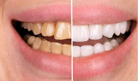 before and after, treatment all on 4 implants in San Miguel de Allender