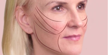 Close-up of woman’s face highlighting deep plane facelift areas overlay