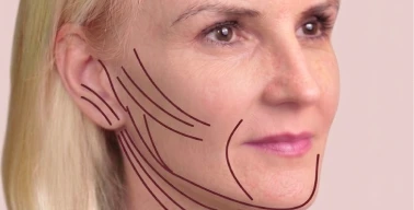 Close-up showing minimal lifting areas around jawline with overlay markings