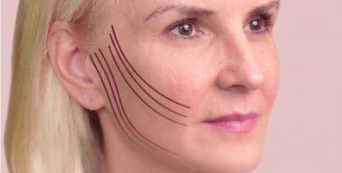 Woman’s face highlighting SMAS layer treatment zones example