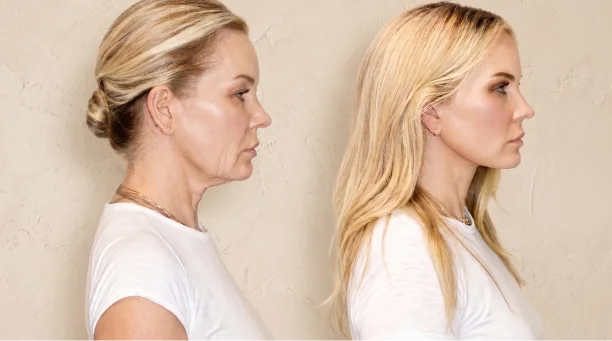 Side profile comparison of woman after facelift in Mexico