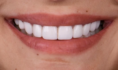 before and after, treatment 3 on 6 implants in San Miguel de Allender