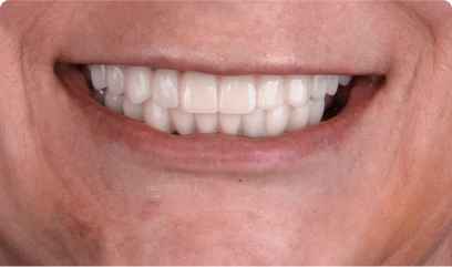 close up shot for a restored smile with 3 on 6 dental implants