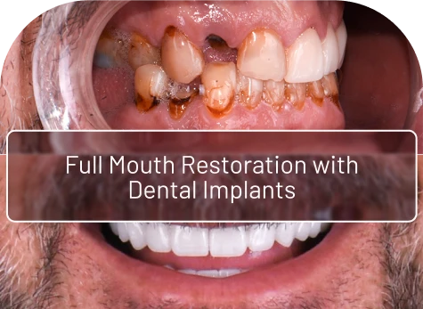 side by side comparison of before and after getting a full mouth restoration