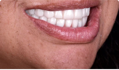 Close-up of snap-on dentures fitting snugly over implants for a removable, yet stable tooth replacement