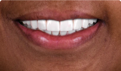 Implant-supported snap-on denture mechanism for easy removal and secure fit