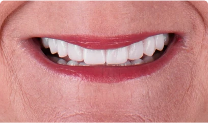 Patient’s smile showing the natural look achieved with implant-supported snap-on dentures