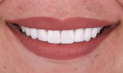 before and after, treatment snap on dentures in San Miguel de Allender