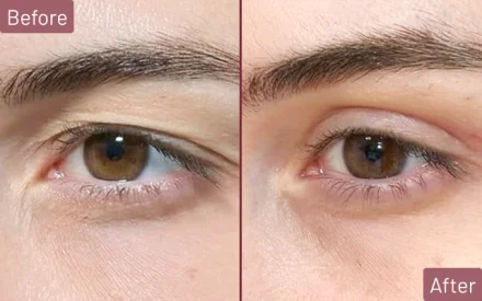 Side profile comparison of woman before and after rhinoplasty in black background