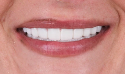 before and after, treatment all on 4 implants in San Miguel de Allender