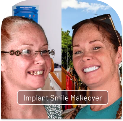 Before and after case of how dental implants restore function and appearance