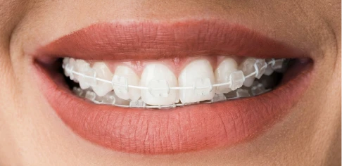 a shot of a Zoom! equipment used in teeth whitening