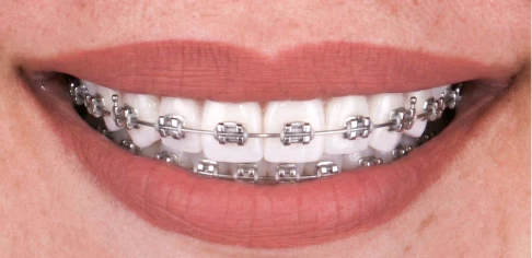 patient under laser whitening teeth treatment