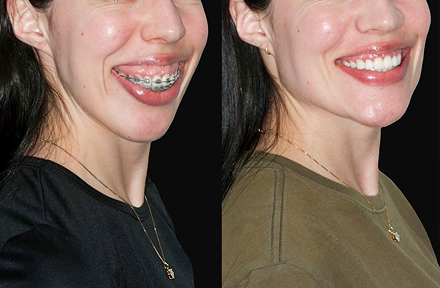 Face lift before and after in San Miguel de Allende highlighting expert rhytidectomy surgery, mini facelift options, and affordable face lift price in Mexico.