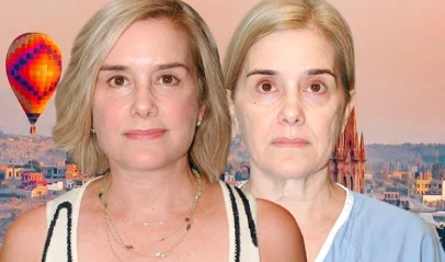 Facial transformation of patient: before and after photos of cosmetic surgery in San Miguel de Allende.