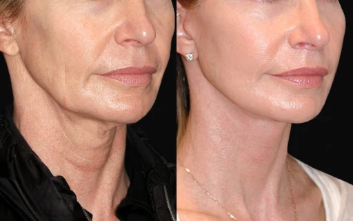 Face lift before and after in San Miguel de Allende highlighting expert rhytidectomy surgery, mini facelift options, and affordable face lift price in Mexico.