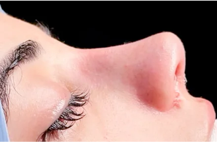 Patient profile showing refined nasal tip and straight bridge after rhinoplasty.
