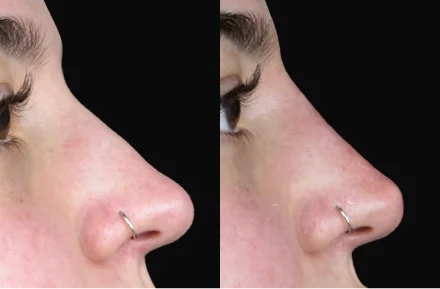 Rhinoplasty side profile result, showing hump reduction and straight bridge.