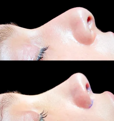 Close-up of the before and after results of rhinoplasty.