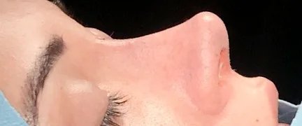 Close-up profile of a straight nasal dorsum post-rhinoplasty.