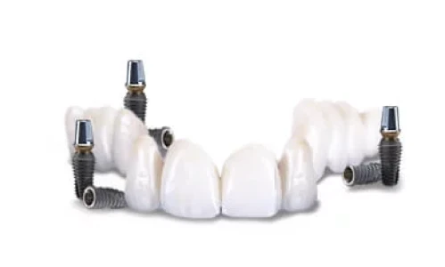 Fixed denture superstructure with six implants and three bridges—long-term smile restoration solution.