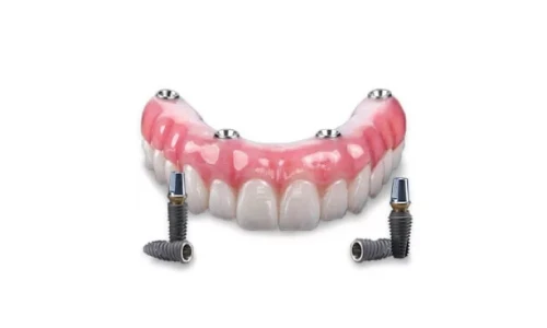 All-on-4 denture superstructure supported by four implants—cost-effective full mouth restoration in Mexico.