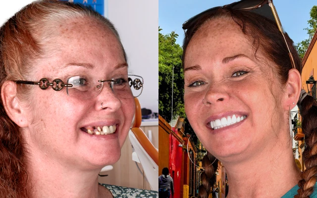 Before and after case of how dental implants restore function and appearance